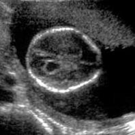 sonographic survey for anomalies that might suggest aneuploidy should follow identification of a choroid plexus cyst Choroid Plexus Cyst survey of the heart, and a survey of the feet and hands to
