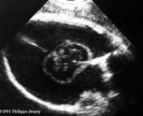 Hydranencephaly Sonographic findings Absence of normal brain tissue