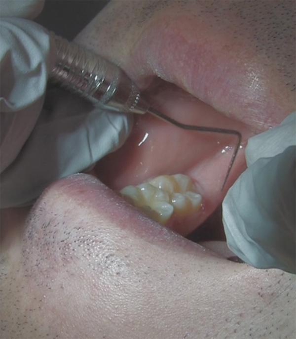 What to Look for During an Oral Examination Mylohyoid Ridge Mandibular Tori (benign bone