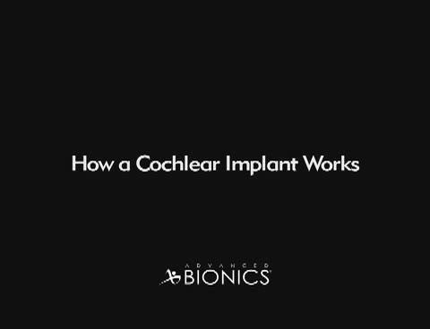 Who is a Candidate for a Cochlear Implant?