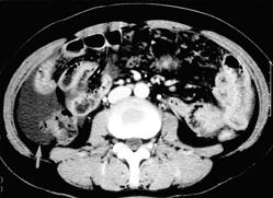 Omental cake and rectal shelf were also seen. A. CT scan shows ascites in right and left subphrenic spaces. B.