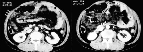 A B Fig. 2. A 42-year-old gastric cancer patient with omental and mesenteric permeation by peritoneal seeded metastsis.
