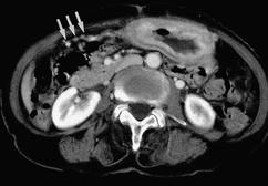 Fig. 4. A 53-year-old gastric cancer patient with false positive interpretation without peritoneal seeding.