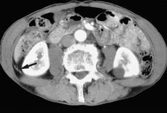 Enlarged perigastric nodes along greater curvature of the stomach maybe sometimes confused with omental tumor seeding. Fig. 5.