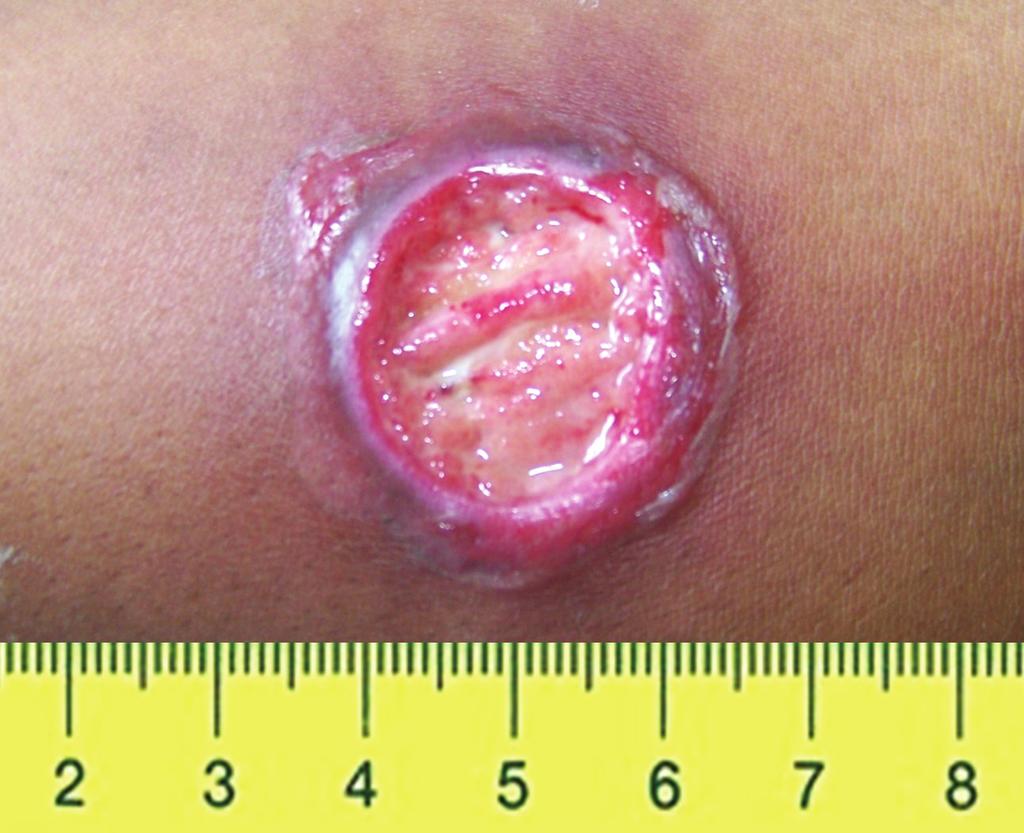 On physical examination, a depressed papular lesion measuring 8 7 mm in the right leg suspicious of folliculitis was noted.