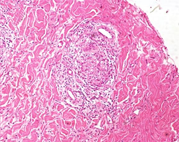 Prior studies have shown parasite DNA in scars of CL patients [14], but herein we found amastigotes in the tissue where the new ulcer developed.