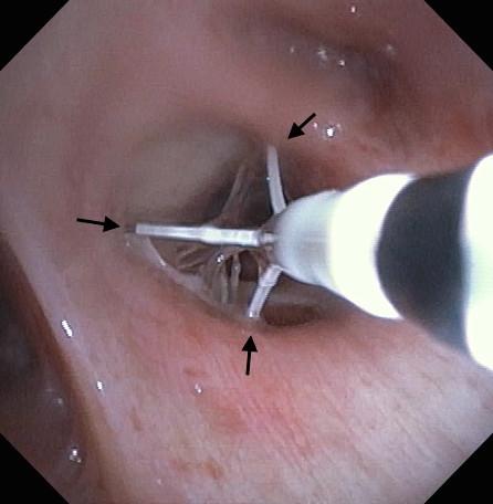 Journal of Visualized Surgery, 2017 Page 3 of 6 Video 2. Treatment of medial-basal segment of right lower lobe Felix Zamora*, Roy Cho, Madhuri Rao, Heidi Gibson, H.