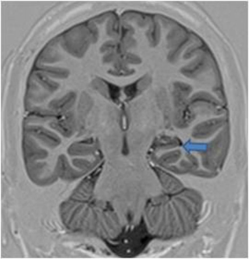 Fig. 7: IR Image showing atrophy with hypointensity of the left Hippocampus