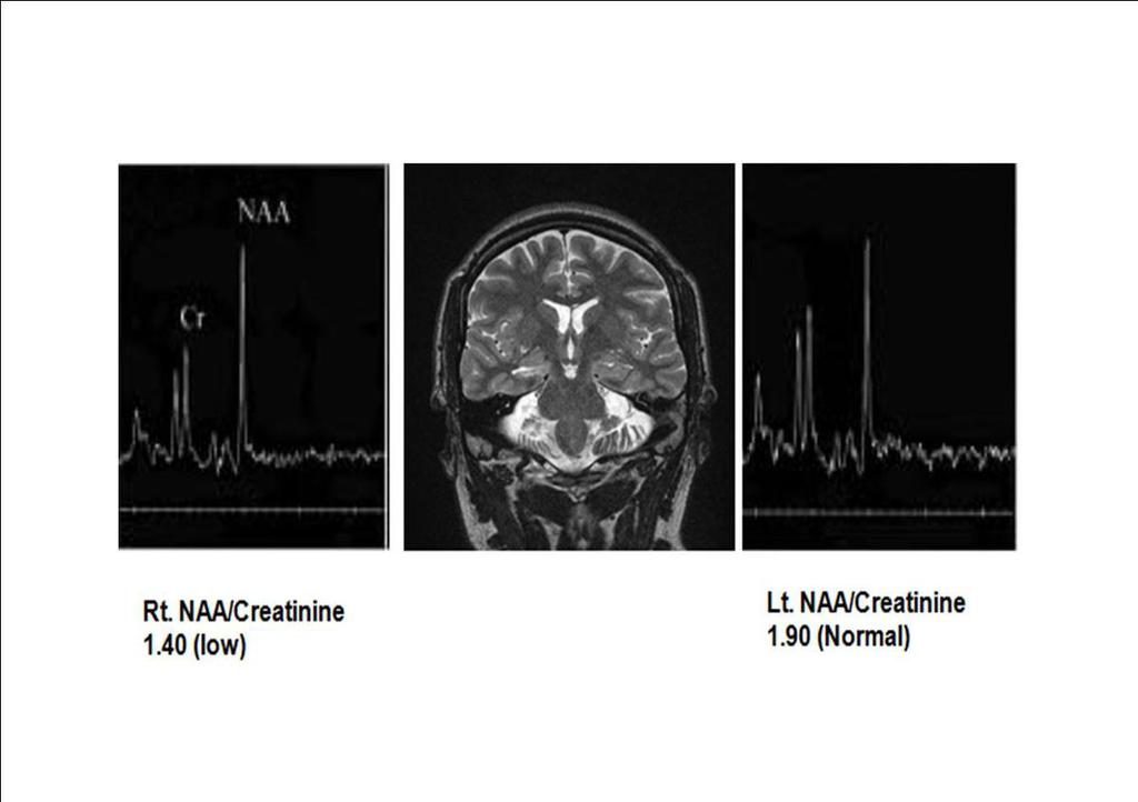 2.N-acetylaspartate and creatine signals can be measured with 1H MRS to assess 2 major pathological features of MTS: decreased NAA for neuronal loss and slightly increased or unchanged creatine for