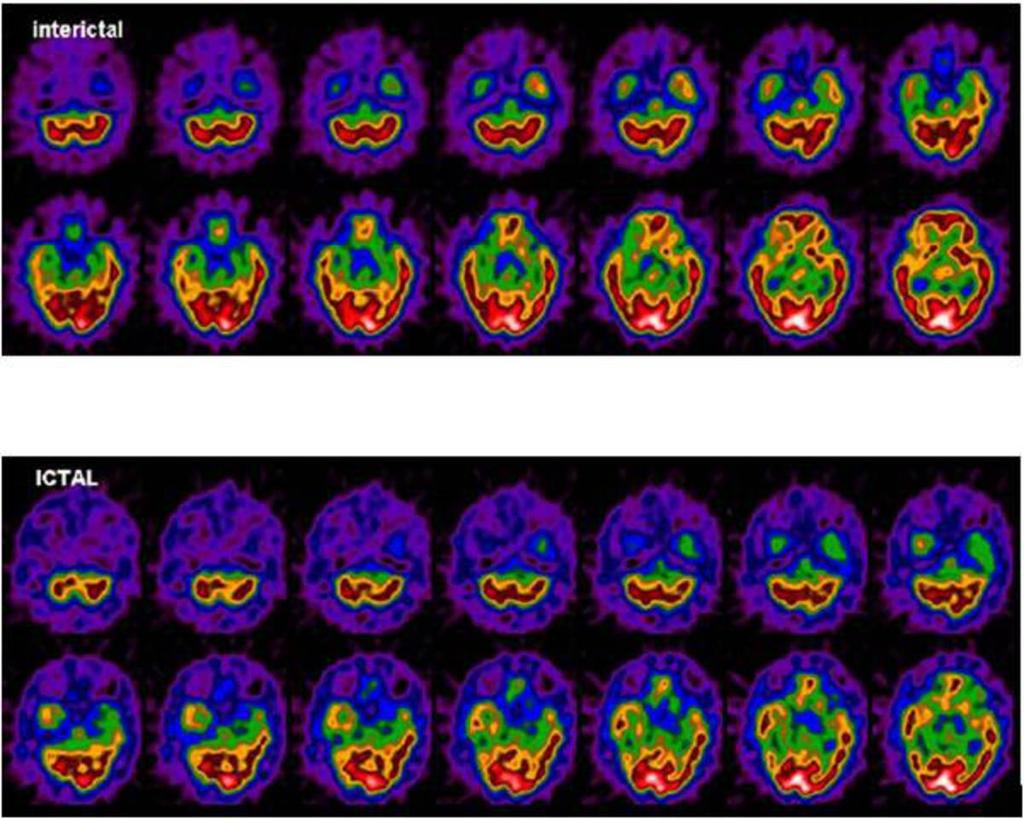 Fig. 11: Images of SPECT scan in a patient presenting with epilepsy showing hypoperfusion in right temporal region in both interictal and ictal phases.