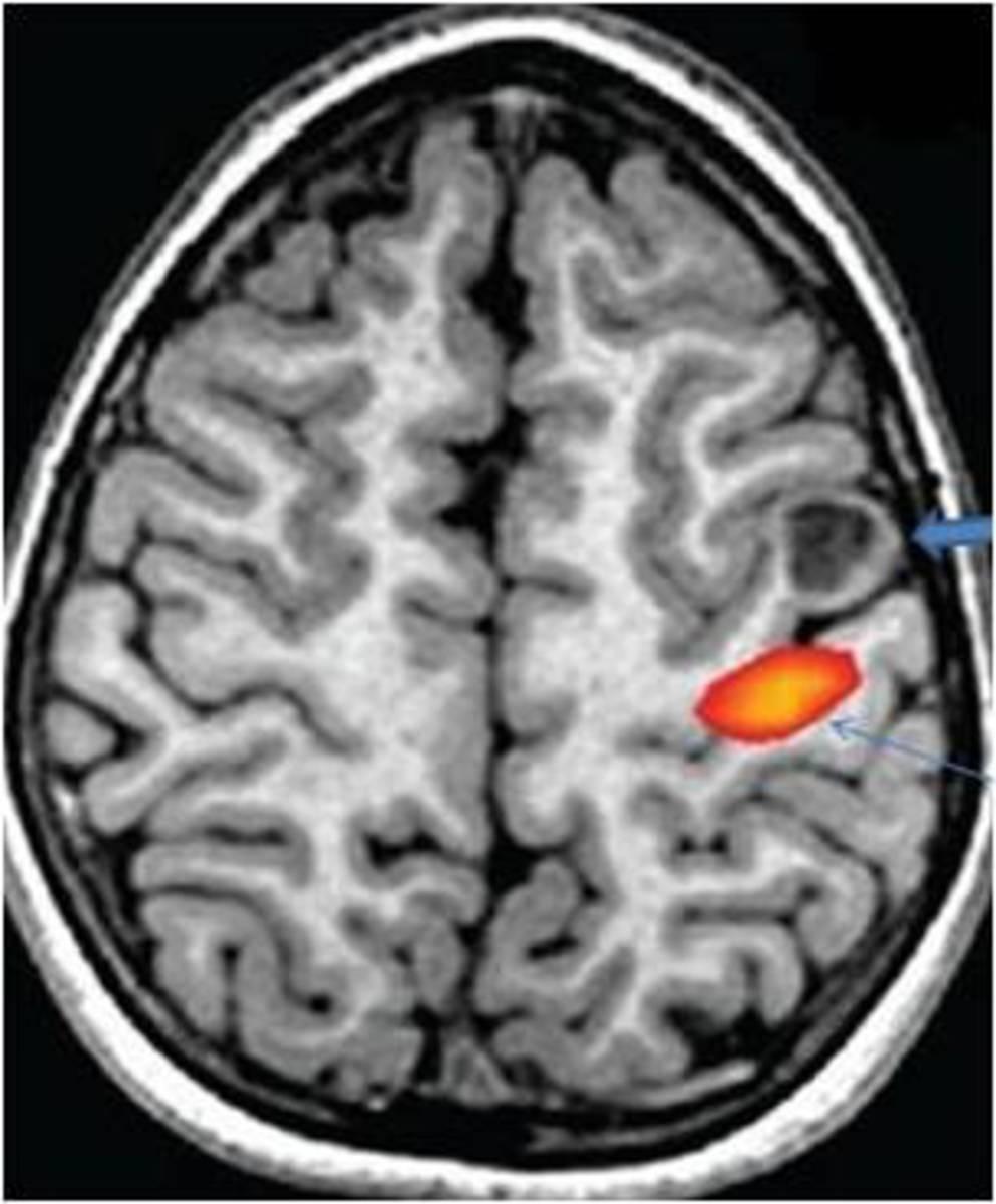 Fig. 12: A 16-year-old with cortical dysplasia (thick arrow) involving precentral gyrus on the left side.