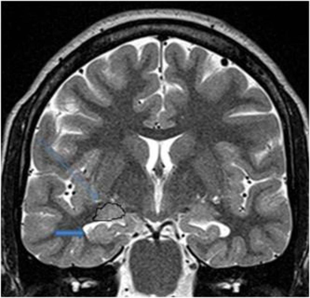 Fig. 3: Coronal TSE T2-weighted MR scan through the head of the hippocampus.
