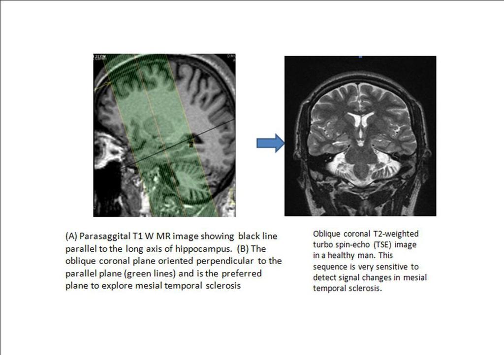 Fig. 5 MAGNETIC RESONANCE FEATURES OF HIPPOCAMPAL SCLEROSIS THAT ALLOW A VISUAL DIAGNOSIS CHANGES IN MORPHOLOGY HIPPOCAMPAL ATROPHY Visual assessment of hippocampal atrophy is the first feature that