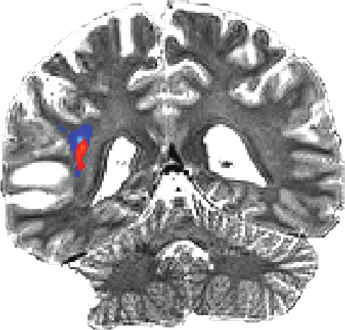 Probabilistic Tractography of