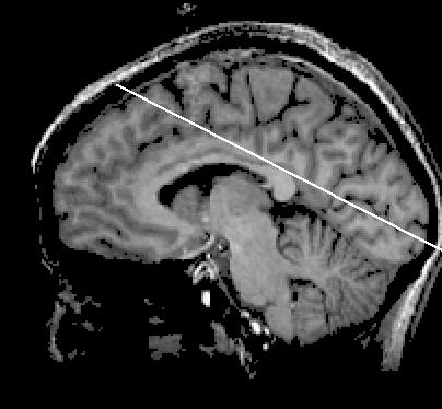 side above calcarine (lower visual field) Lingual gyrus
