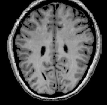 and above collateral sulcus (upper visual field)