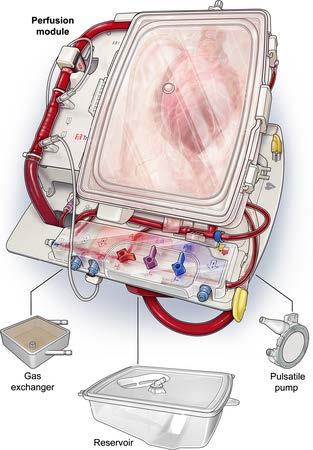 Transmedics Organ Care System 1.2 1.