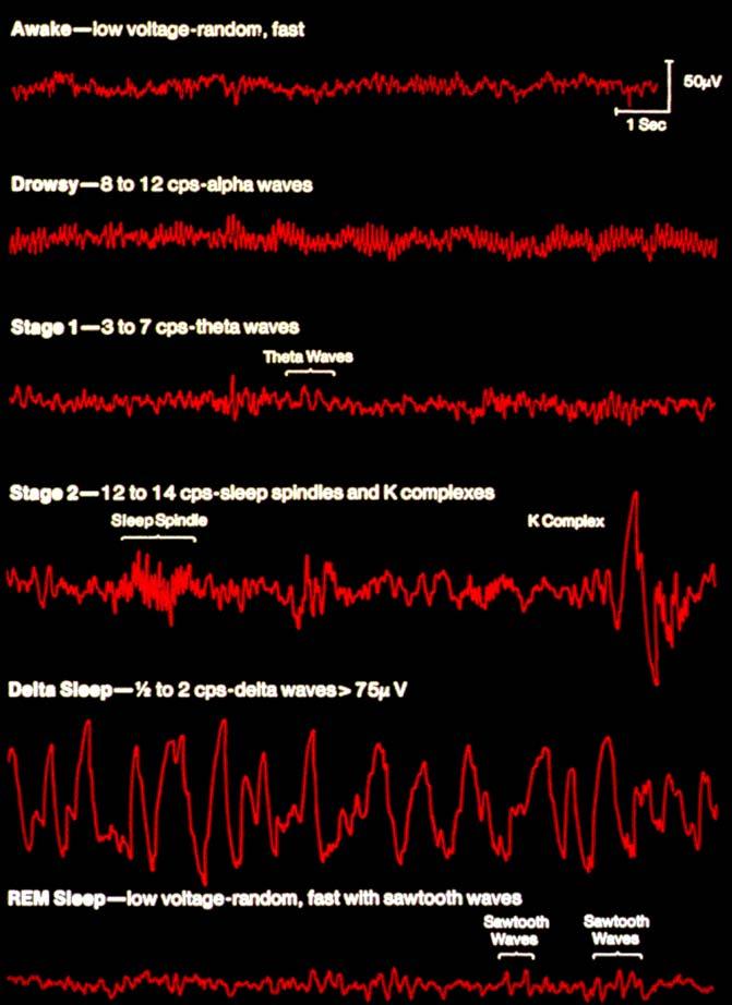 Sleepiness = propensity to fall asleep physiologically EEG
