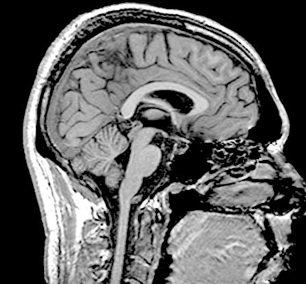 metabolism in thalamus, prefrontal cortex, and inferior parietal cortex.