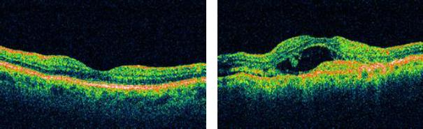 One test is an OCT (Ocular Coherence Tomography) scan of the macula. The scan is safe, painless, quick and provides the ophthalmologist with a high resolution image of the macula.