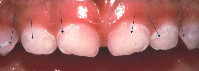 Early Tooth Decay White Spots (pre-cavities)