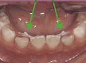 or loose tooth (injury) Gums are