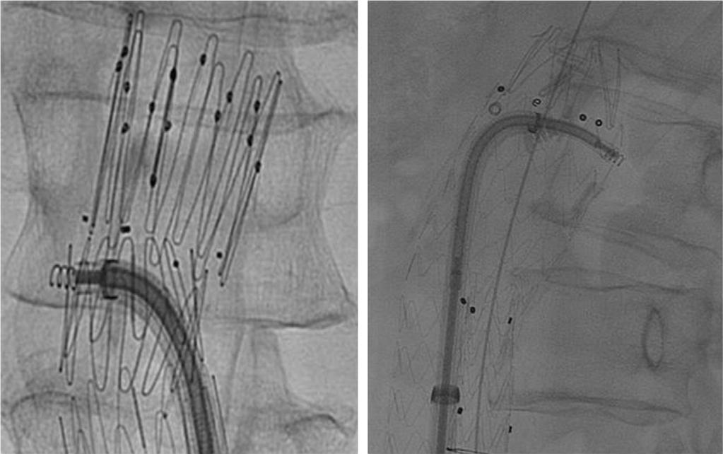 Results of the ANCHOR prospective, multicenter registry of EndoAnchors for type Ia endoleaks and endograft migration in patients with challenging anatomy William D.