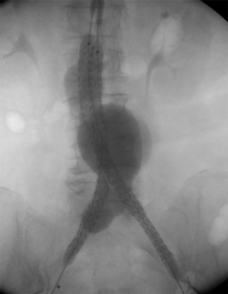 5%) had saccular aneurysm with aorto-iliac aneurysm and two cases (25%) were juxtarenal AAA. The mean aneurysm diameter was 63.2+22.2 mm (28.2 to 91.3 mm), mean proximal neck diameter 22.16+4.