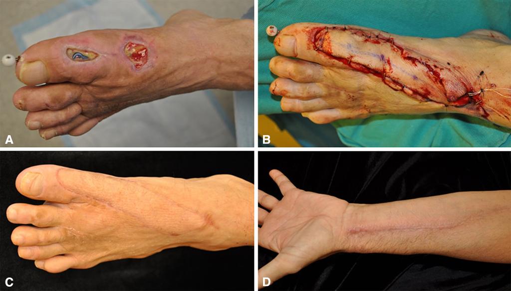 Volume 472, Number 6, June 2014 Foot and Ankle Surgical Wounds 1927 Fig. 3A D A 67-year-old man underwent arthrodesis of the first toe for hallux varus deformity.