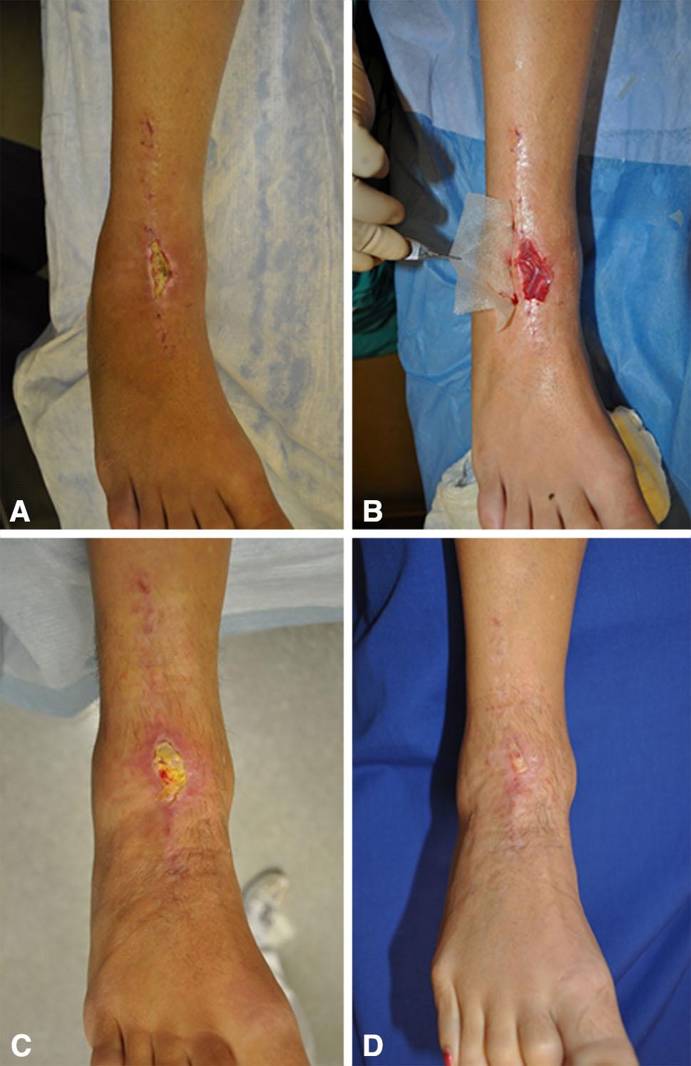 1928 Cho et al. Clinical Orthopaedics and Related Research 1 Fig. 4A D A 61-year-old woman with ankle arthritis underwent total ankle arthroplasty.