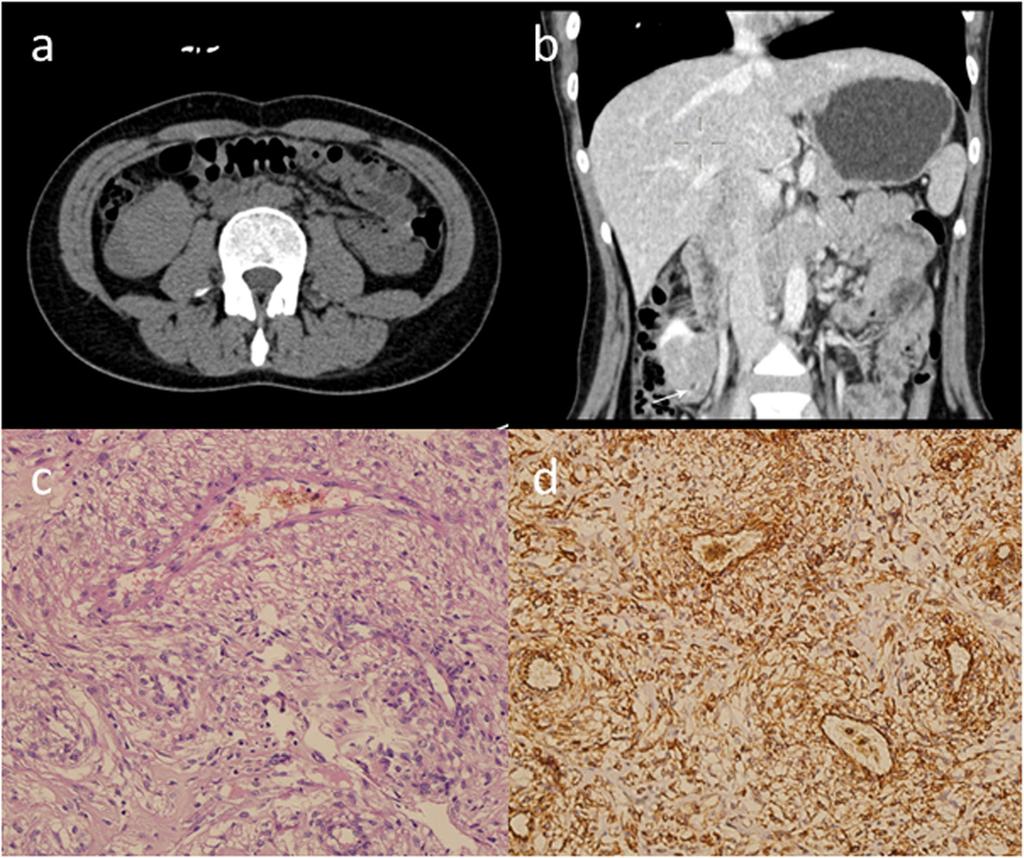 Contrast-enhanced CT image of venous phase (b) and coronal reconstruction image of delayed-phase (c) demonstrate heterogeneous enhancement with E-AML are younger than classical AML patients (38.6 vs.