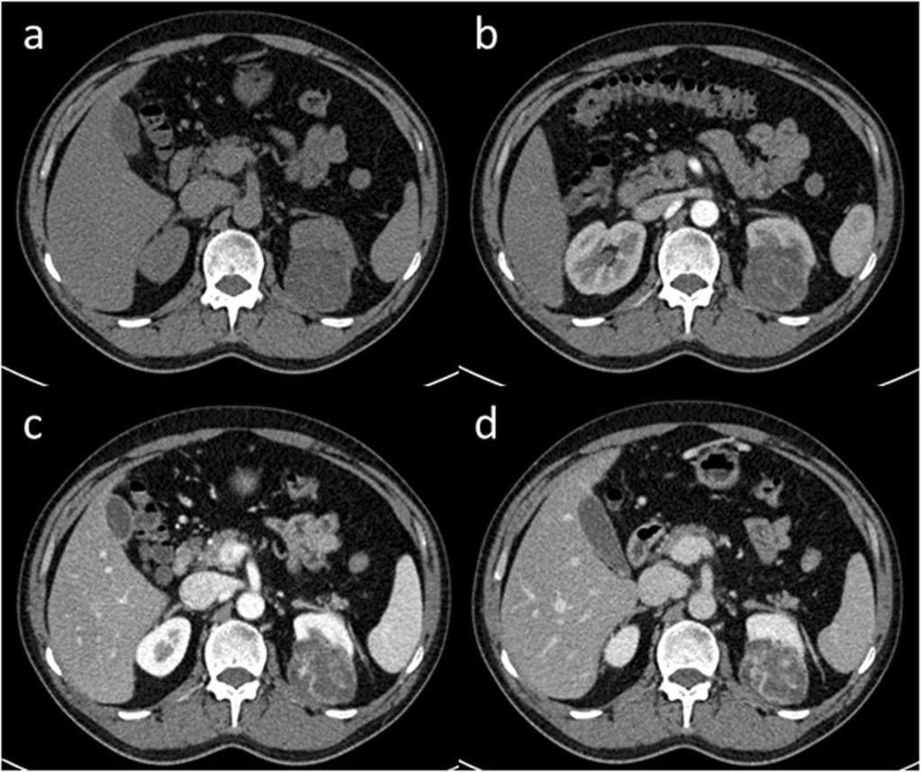 Liu et al. World Journal of Surgical Oncology (2015) 13:280 Page 5 of 6 Fig. 4 A 41-year-old male with an incidentally discovered left-sided renal mass.