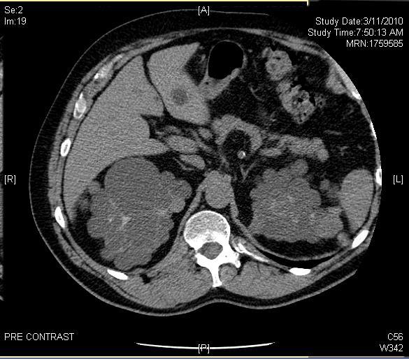 Compare the appearance of cystic kidneys on your patient s CT scan with an