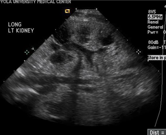 Note that the cystic areas are sonolucent (ultrasound), but moderately radiodense on