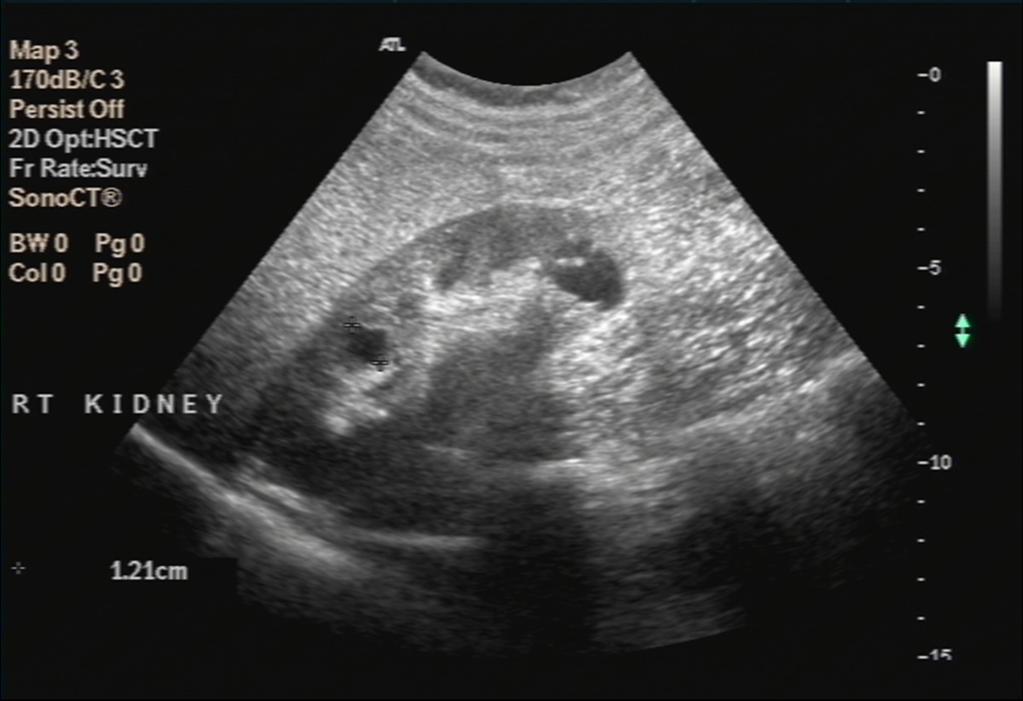 Fig. 1: US demonstrates a well-defined lesion with enhanced