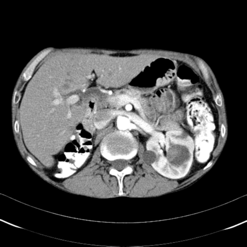 Fig. 2: CT shows complicated cyst in left kidney, 3.