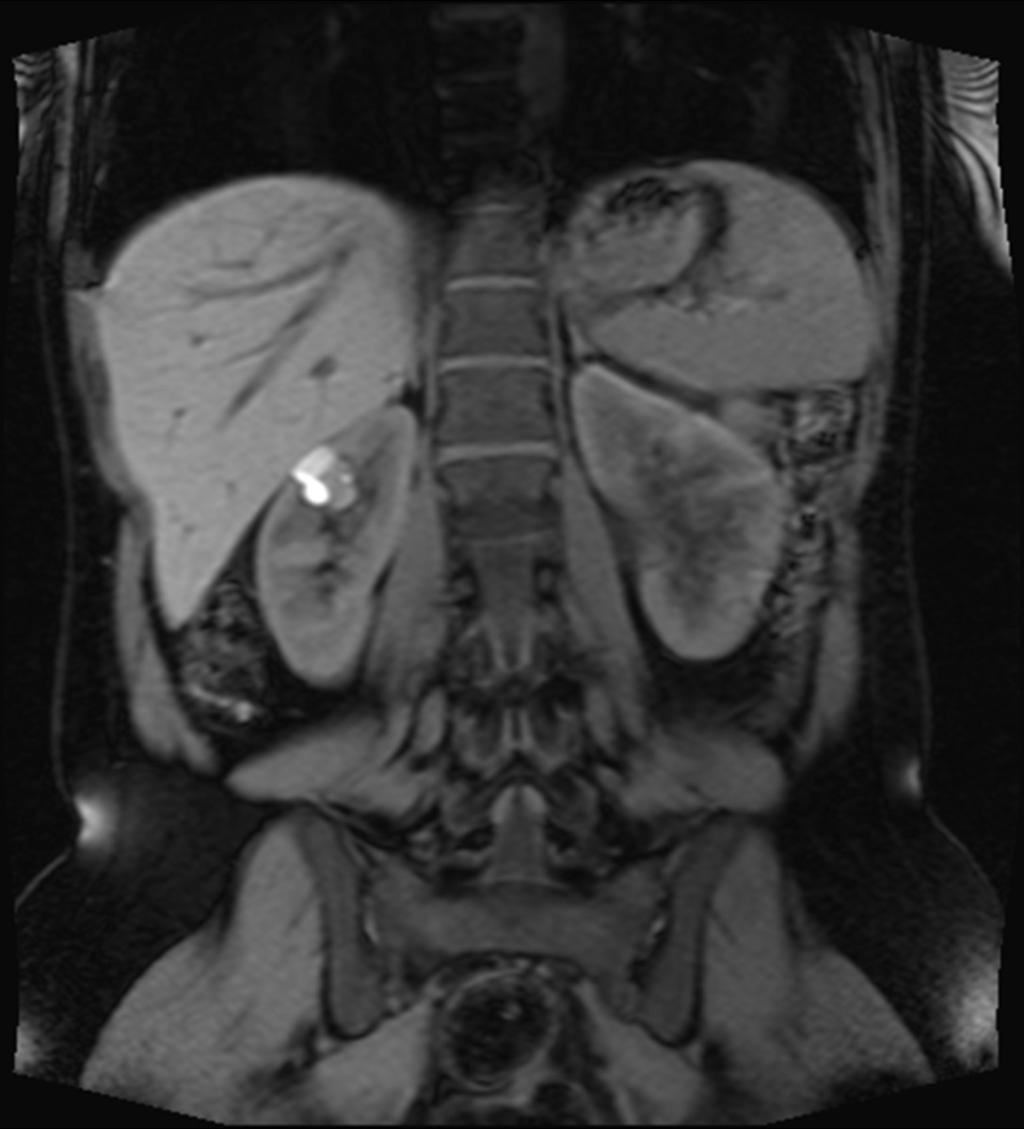 Fig. 3: MRI shows complicated cyst in right kidney, 2.