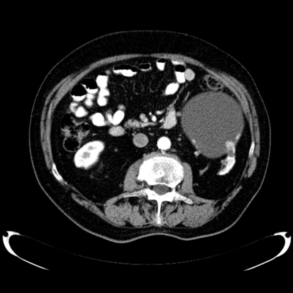 Fig. 4: CT shows cyst in left kidney, 12 cm, with solid nodular areas