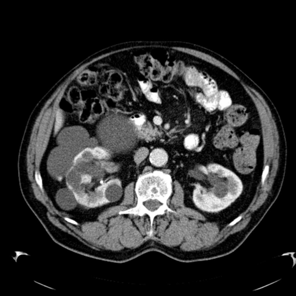 Fig. 5: CT shows multiple bilateral hypodense cystic masses, some containing thin