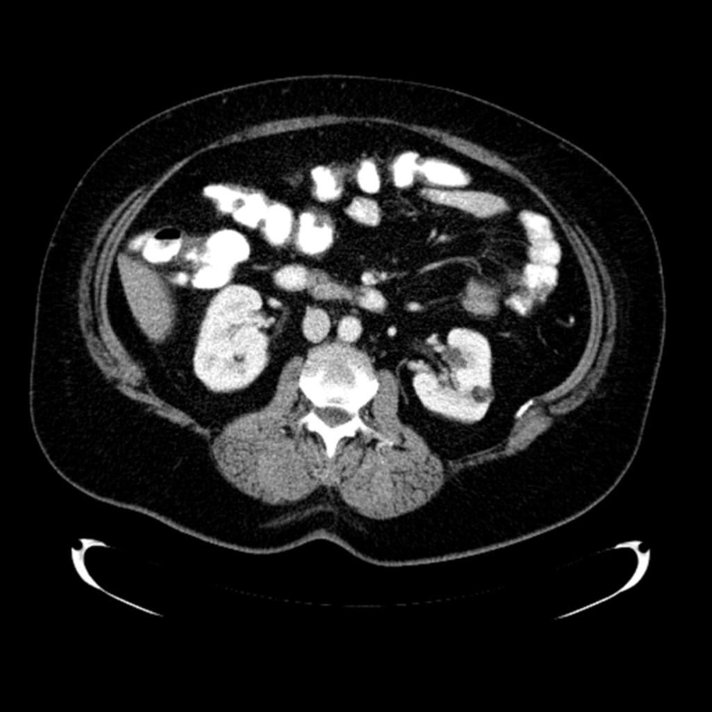 Fig. 7: detection by CT of even a small amount of fat within a renal mass establishes the