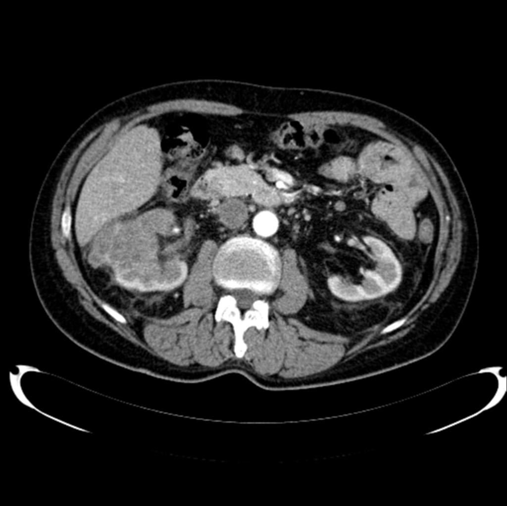 Fig. 10: CT demonstrates tumorous mass in right kidney with