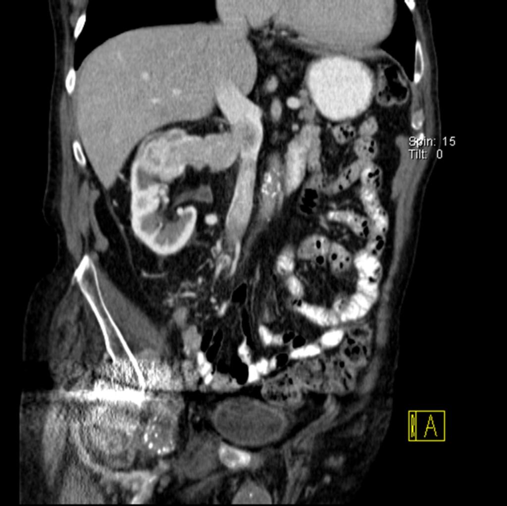 Fig. 11: tumorous mass in right kidney spreading in