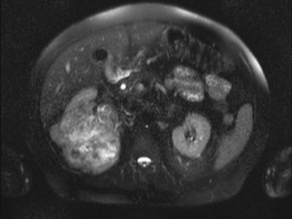 Fig. 12: MRI shows solid tumorous mass in right kidney with
