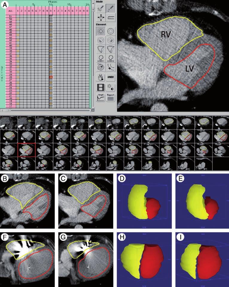 Recent developments in cardiac CT REVIEW RV LV I Figure 5. Ventricular function ana lysis for a 56 year-old female patient (patient 1, A E) and 76 year-old male patient (patient 2, F I).