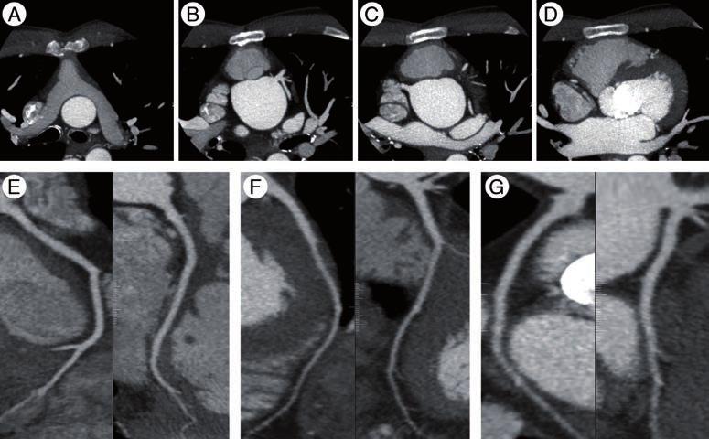 Recent developments in cardiac CT REVIEW In addition, diluting the contrast agent lowers viscosity that facilitates injection speed through the small-gauge catheters.