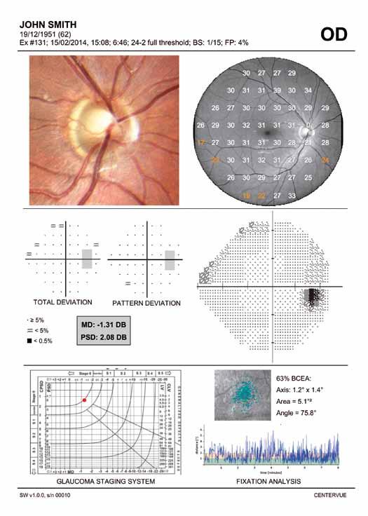 Fixation Analysis In Glaucoma How to Read Printouts Studies have demonstrated abnormal fixation characteristics in patients diagnosed with early Primary Open Angle Glaucoma (POAG) and Advanced