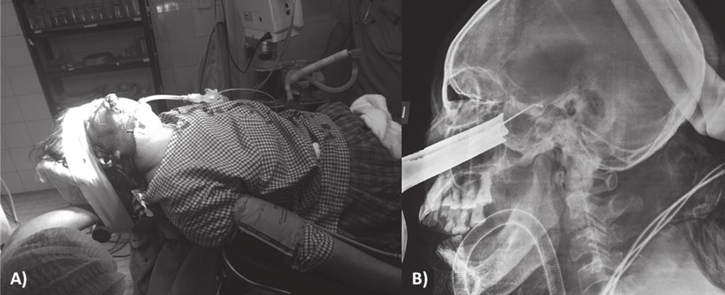 Shrestha et al Figure 1: Intraoperative pictures, A) positioning of patient, supine with about 20 degree head up, B) intraoperative check X-ray to confi rm the anatomical location Dectection of
