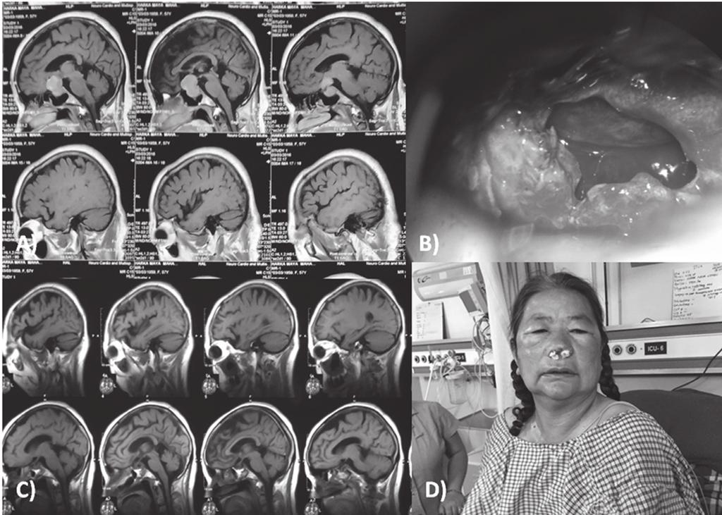 Pituitary Adenoma Figure 2) Illustration 1, A) pre-op MRI brain T1 contrast sagittal image showing huge pituitary adenoma, B) intra operative picture showing exposure of diaphragm sella and arachnoid