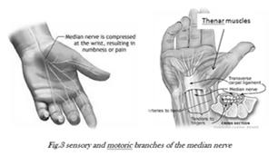 Carpal Tunnel Syndrome Compression of the