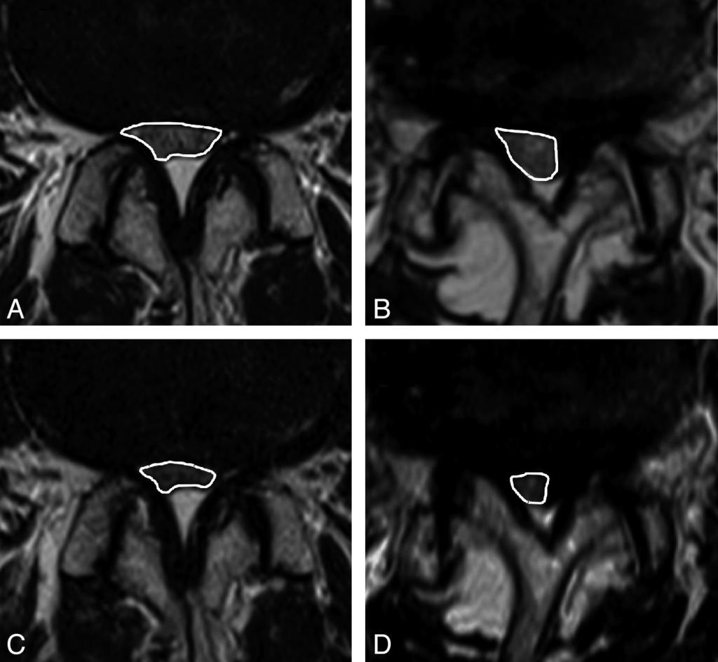 Fig 1. The measurement of DCSA on conventional MR imaging and axial loaded MR imaging in representative patients with SpS (A and C) and DS (B and D). The white lines indicate the outlines of the DCSA.